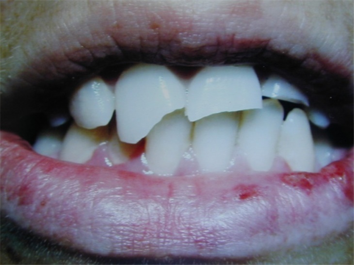 Traumatologia dentale o Dentoalveolare